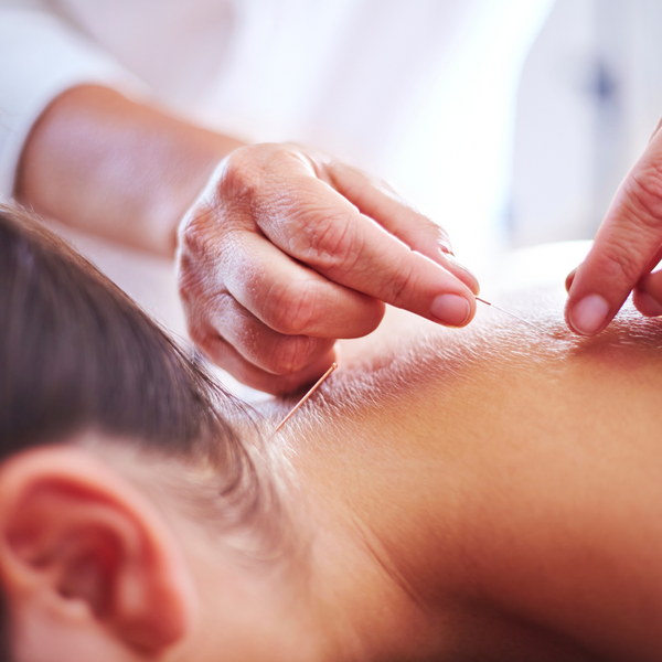 Acupuncture in the upper back