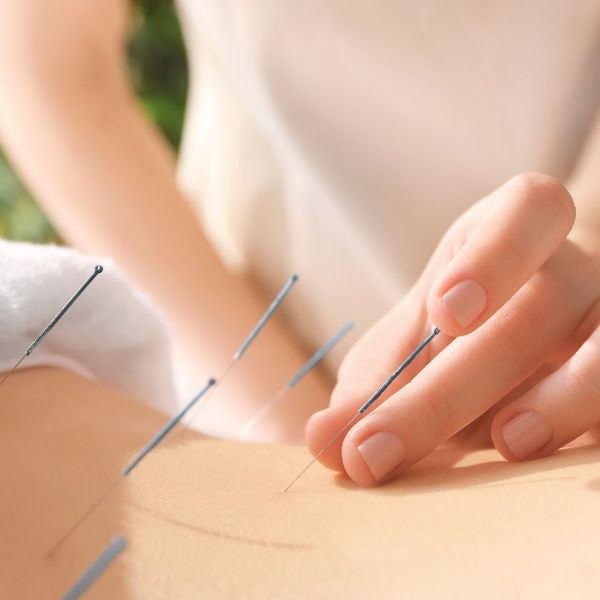 Acupuncture Technique 