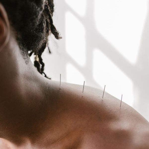 Man getting acupuncture