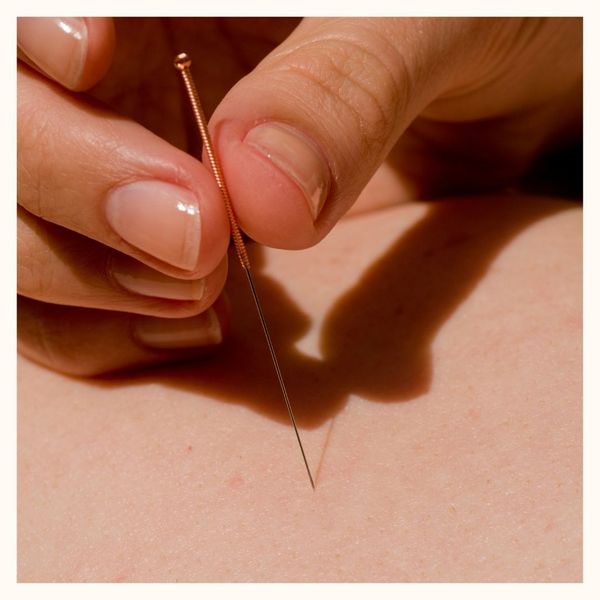 Acupuncture