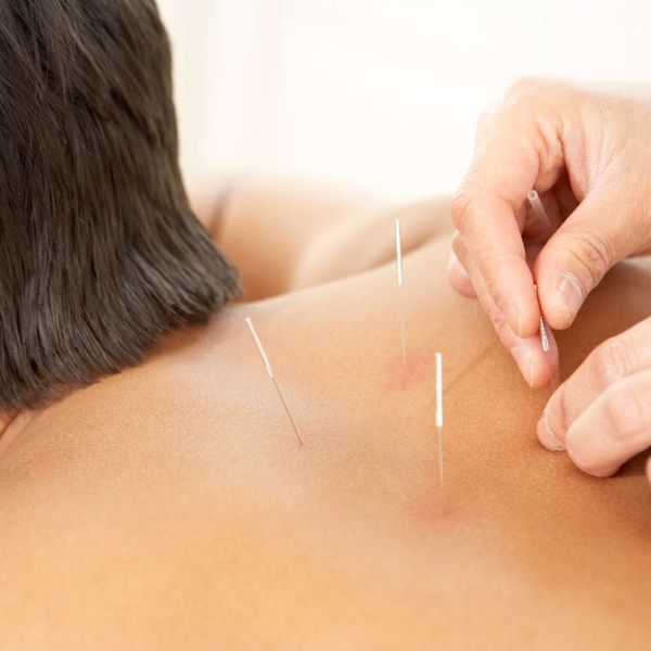 Acupuncture on man's back