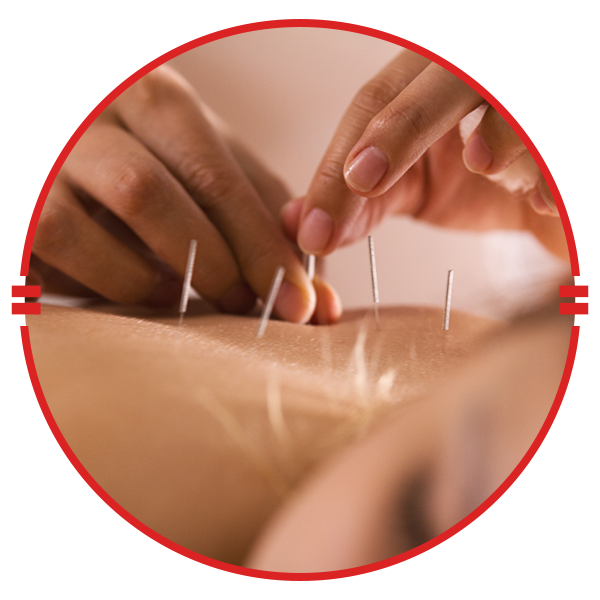 acupuncture needles on back, soft focus