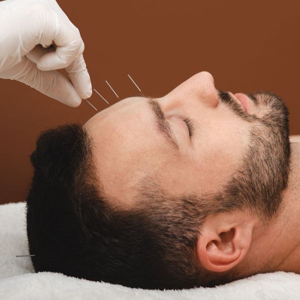 man getting acupuncture for migraine