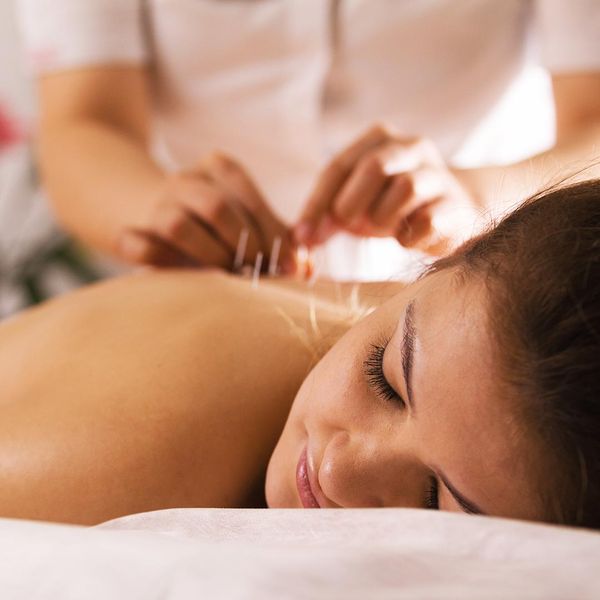 Relaxed woman receiving acupuncture