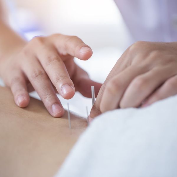 person inserting acupuncture needles into someone's back