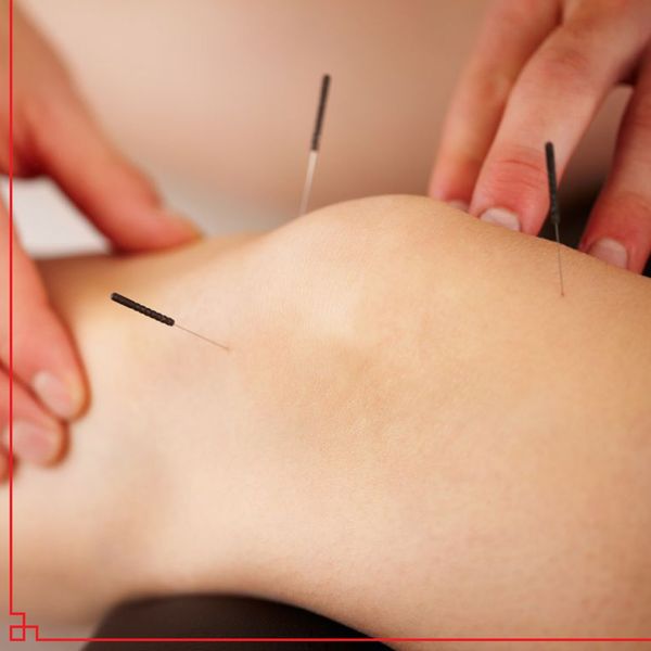 Acupuncture on knee
