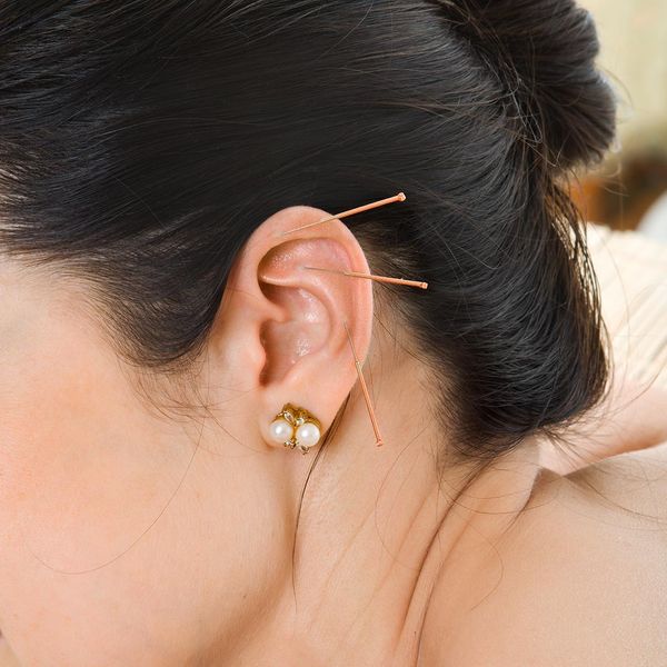 Woman receiving acupuncture to her ear