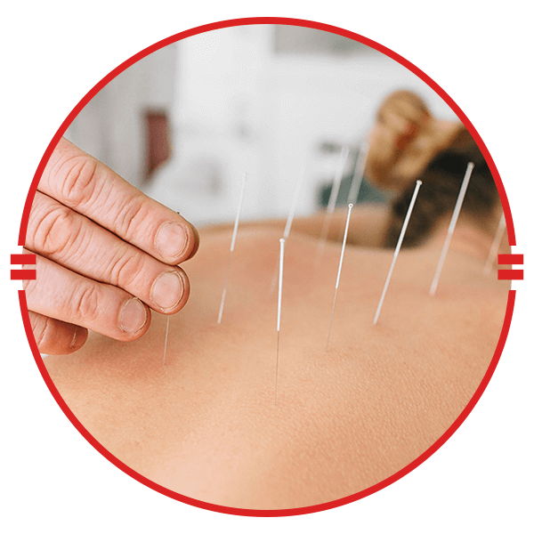 person getting acupuncture therapy on back
