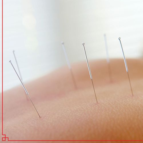 closeup of acupuncture