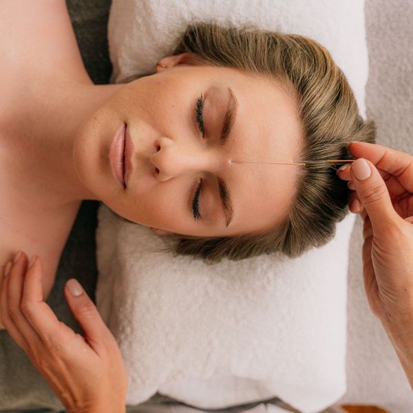 woman undergoing acupuncture