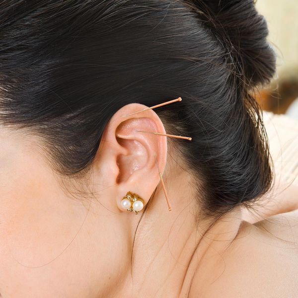 Woman with acupuncture needles in her ear