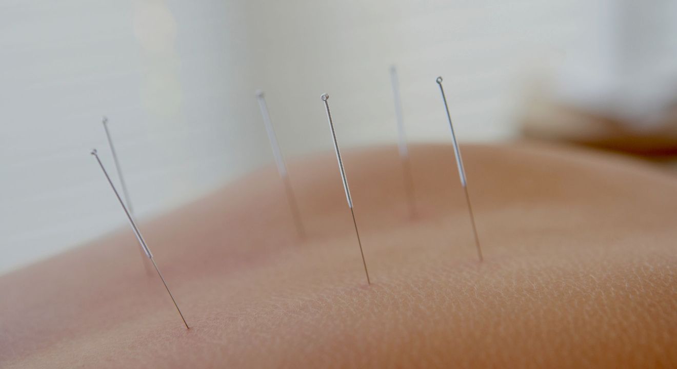 Acupuncture needles in someones back