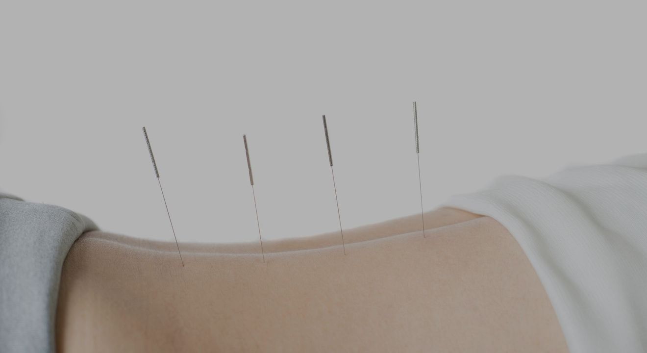 Acupuncture