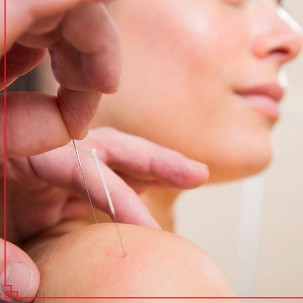 Acupuncture being done on a woman