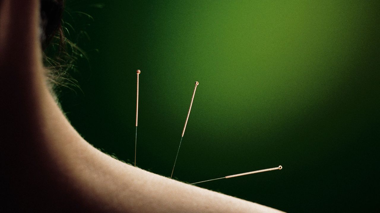 Acupuncture on Shoulder 