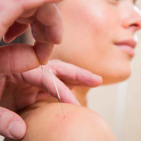 Woman receiving acupuncture on her shoulder