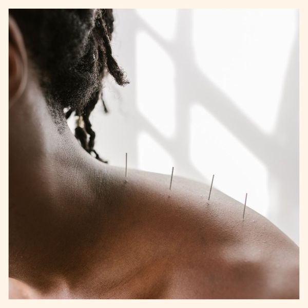 Acupuncture on woman's shoulder