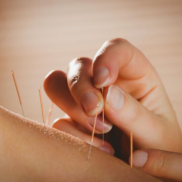 Acupuncturist inserting acupuncture needles