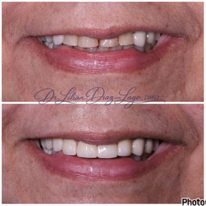 smile transformation before and after