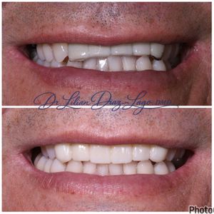 smile transformation before and after