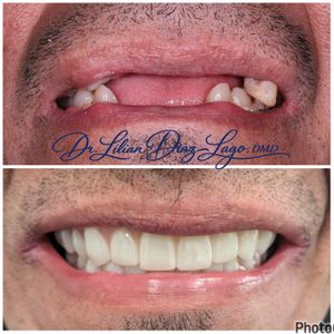 smile transformation before and after