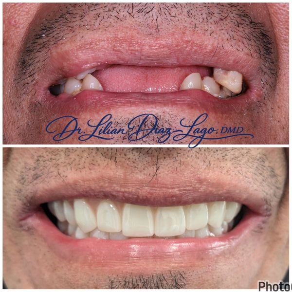 smile transformation before and after