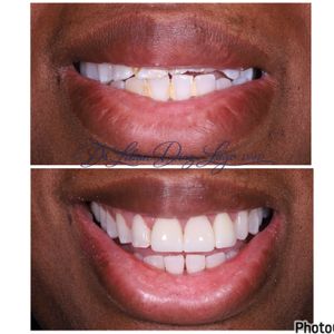 smile transformation before and after