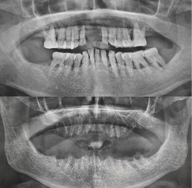 extraction bef&aft (1).jpg
