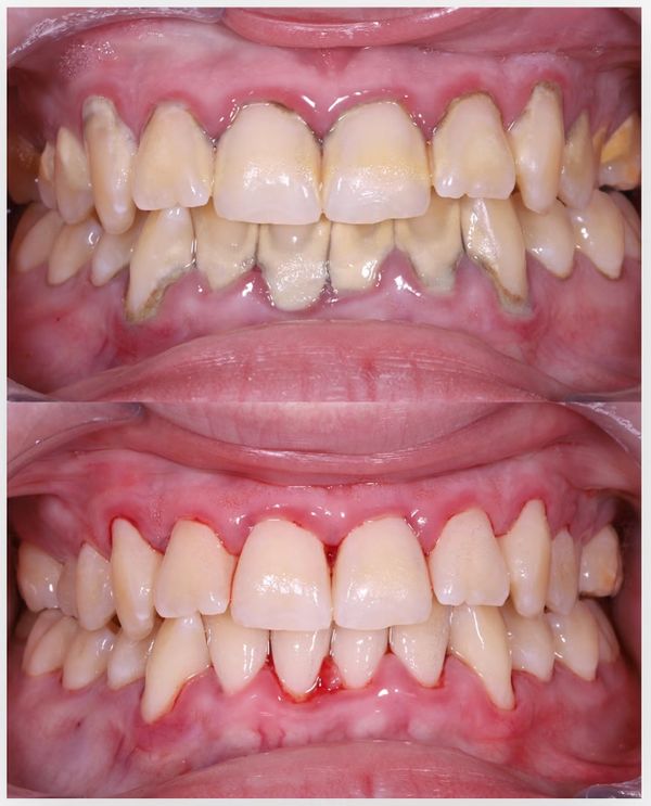 deep cleaning before and after