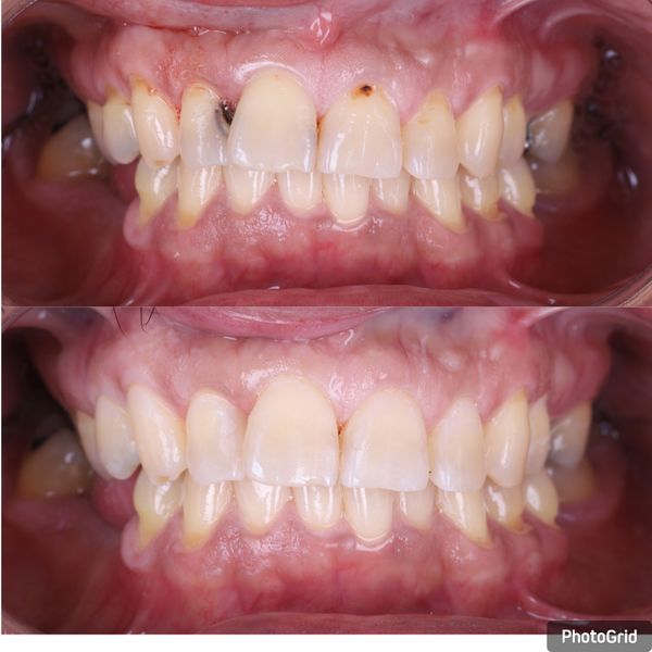 Fillings Bef&Aft.jpg