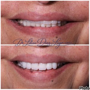 smile transformation before and after