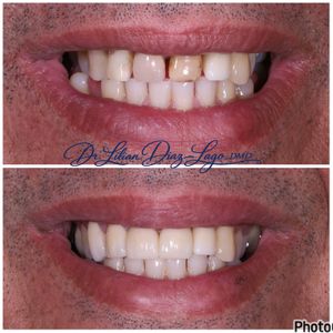 smile transformation before and after