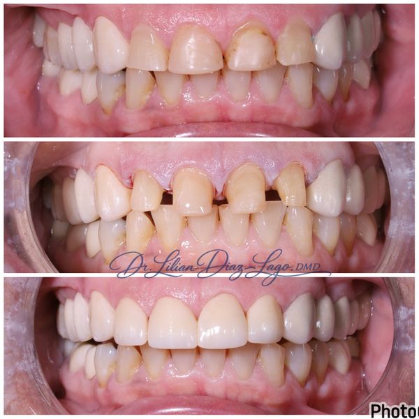 before and after crowns