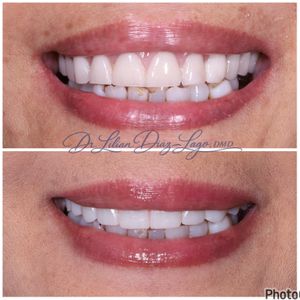 smile transformation before and after