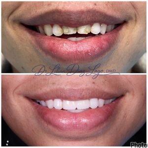 smile transformation before and after