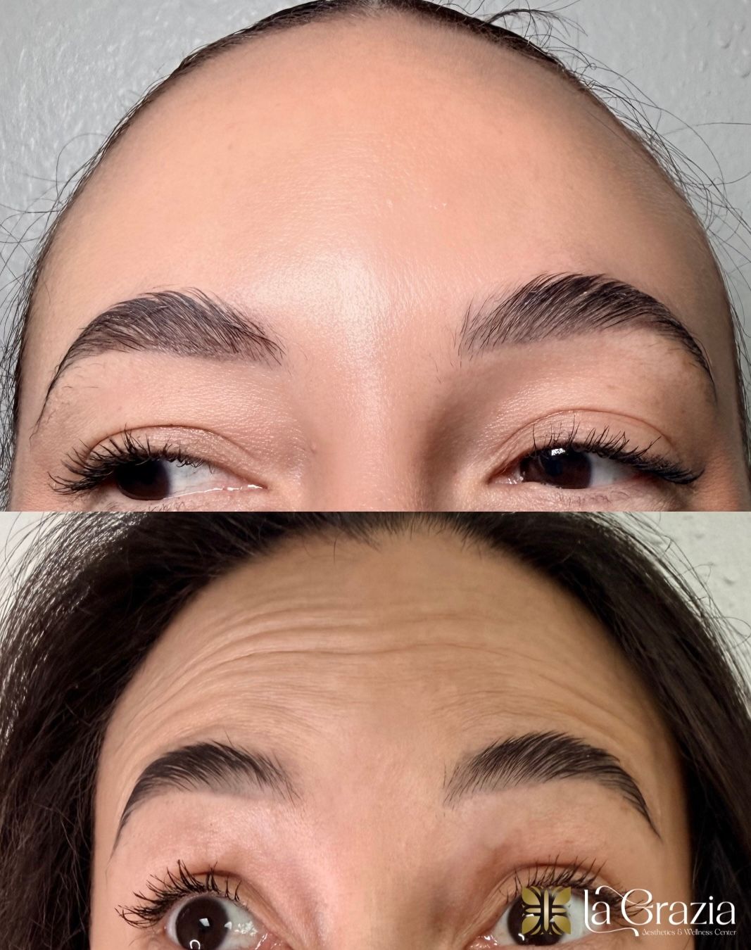 Before/After Jeuveau