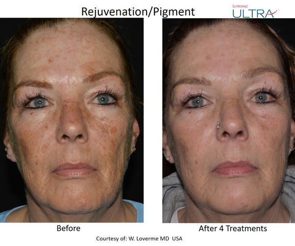 Ultra Loverme Rejuvenation Pigment 5 Frontal.jpg