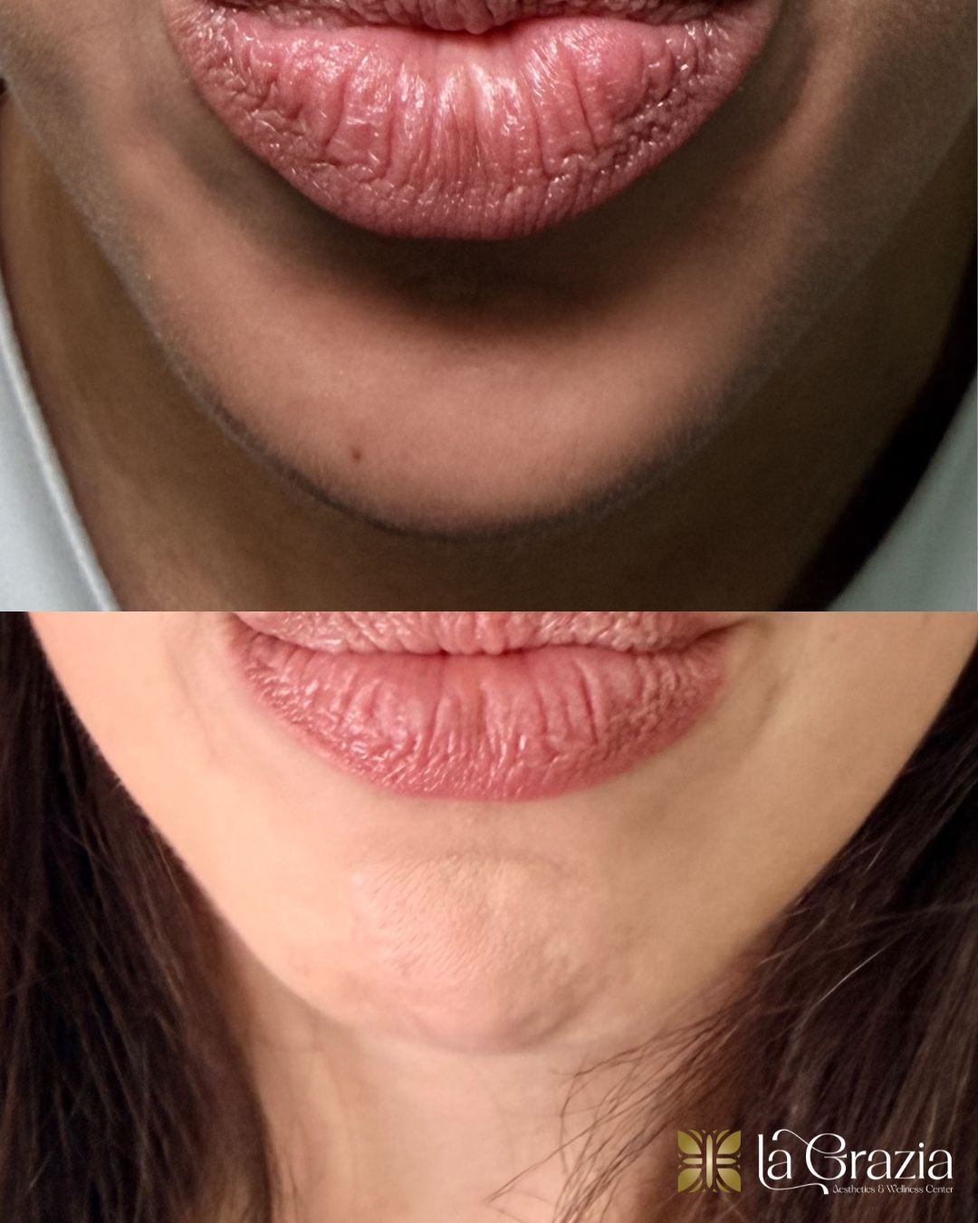 Before/After Jeuveau