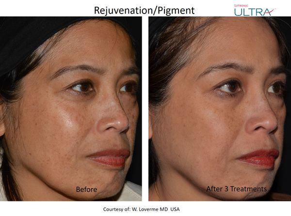 Ultra Loverme Rejuvenation Pigment 6 Right.jpg