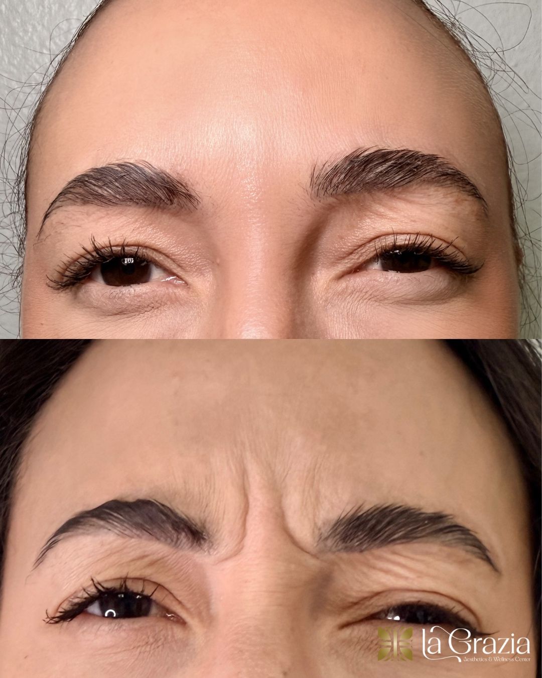 Before/After Jeuveau