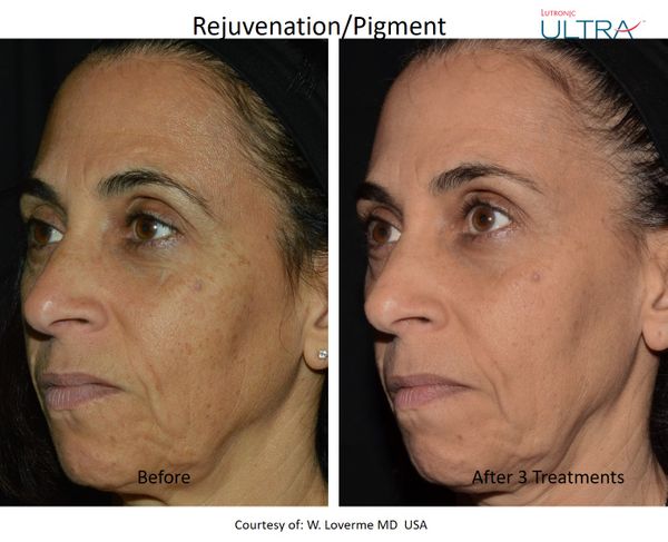 Ultra Loverme Rejuvenation Pigment 11 Left.jpg