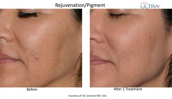 Ultra Loverme Rejuvenation Pigment 12 Left (1).jpg