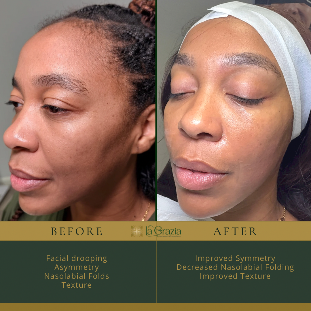 Before/After Morpheus & Forma