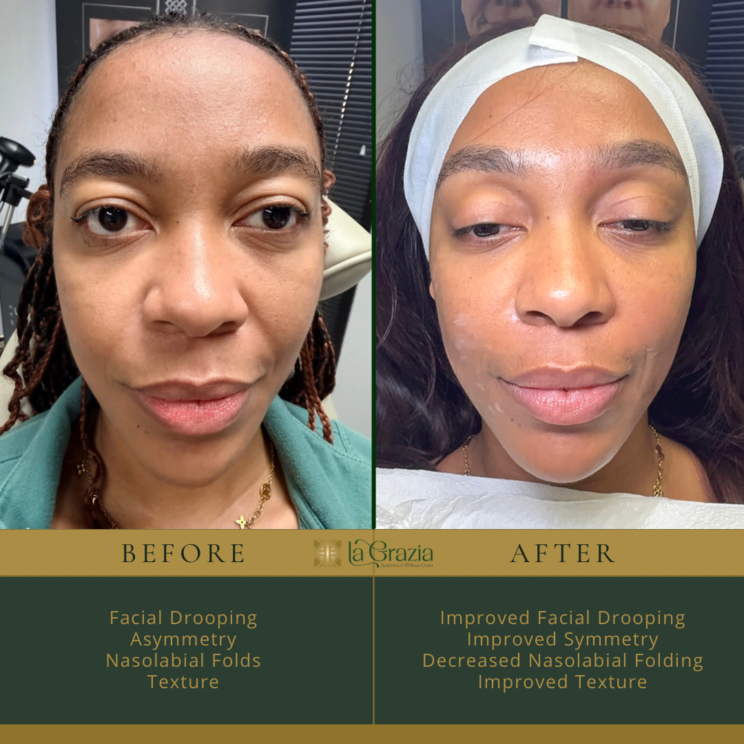 Before/After Morpheus8 & Forma