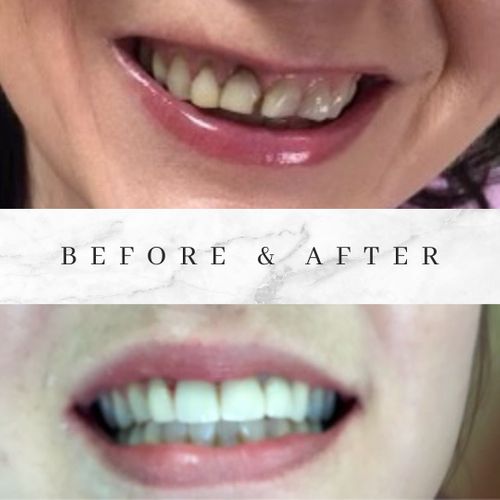 before and after dental implant surgery