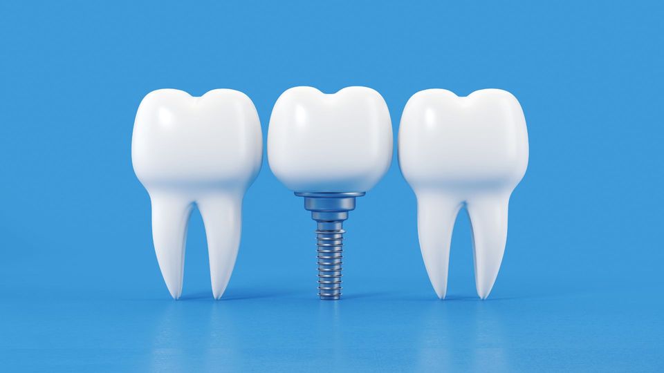 Why Dental Implants Are the Best Solution for Missing Teeth .jpg