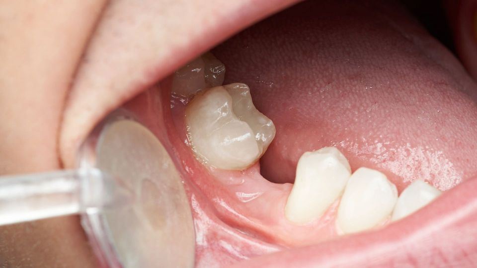 The Advantages of Dental Bridges .jpg