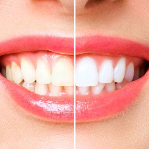 woman's teeth whitening before and after