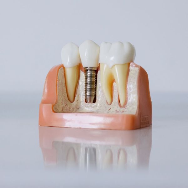 Why Dental Implants are the Best Investment for Your Smile-image1.jpg