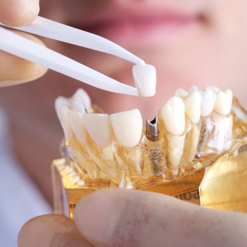 dentist using dental implant visual
